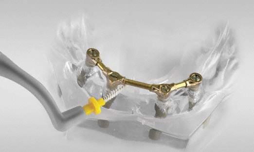 Implantatgestützte Stegprothese