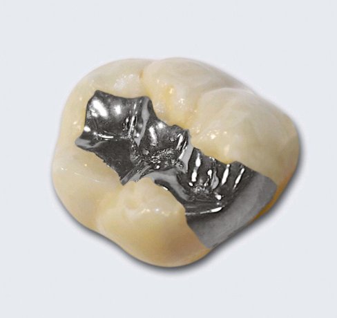 Füllungen amalgamfuellung13-jpg