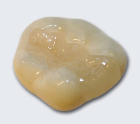 Füllungen keramikinlay10.jpg