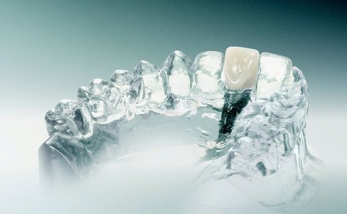 Implantologie 0000019bcd0cd2d33.jpg