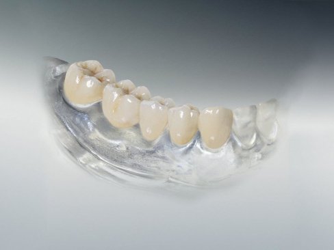 Zahnersatz bild5ze.jpg